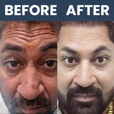Botox Result -1